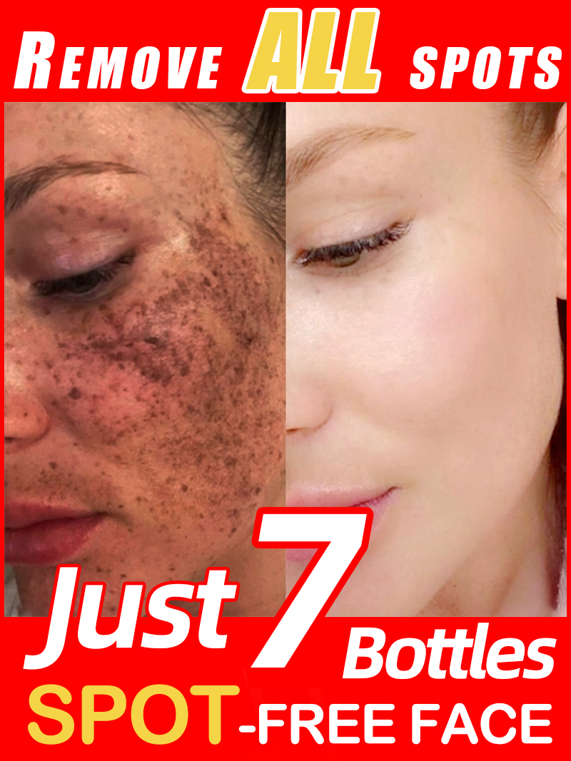 Lighten Freckles Melasma, Faci - Luxury Skincare Essence recension och pris